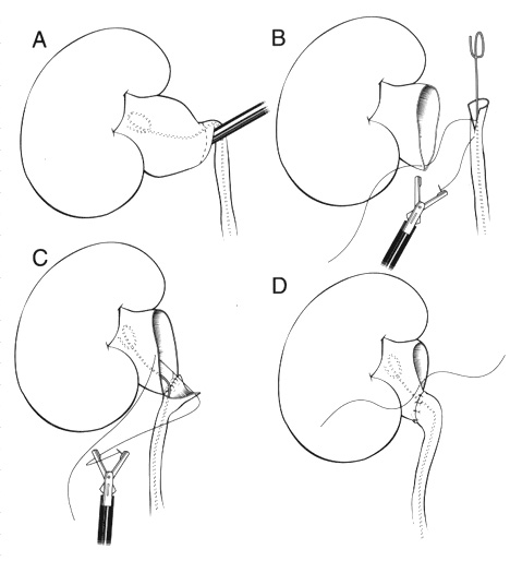 Laparoscopic dismembered pyeloplasty
